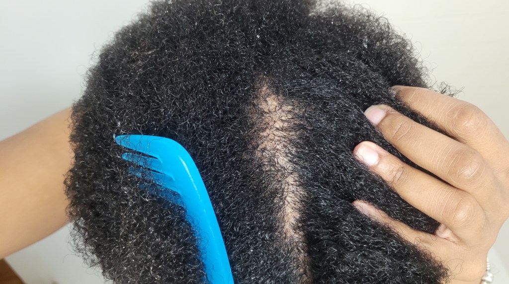 Dealing with CCCA Alopecia: How I Found&nbsp;Out